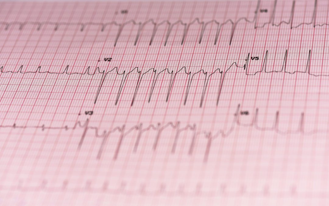 EKG and 24 hour Heart Rhythm Monitoring