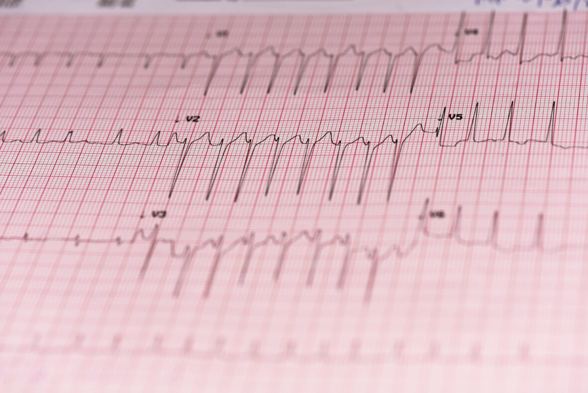 EKG and 24 hour Heart Rhythm Monitoring